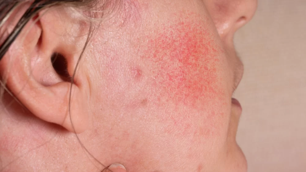 Can I Use Veterinary Ivermectin Topically on My Skin? What You Need to Know